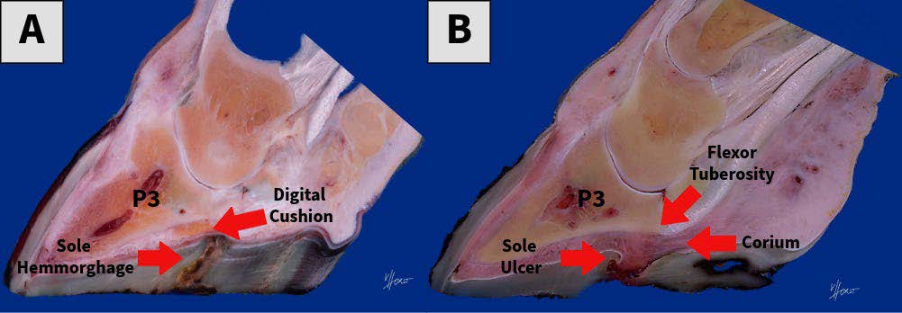 Cross-sectional comparison of two cattle hooves. Panel A shows sole hemorrhage beneath the sole near the tip of the pedal bone (P3) and digital cushion. Panel B shows a sole ulcer extending into the corium beneath the flexor tuberosity of P3, with arrows identifying key hoof structures.