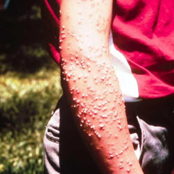 Pustules on arm resulting from IFA stings