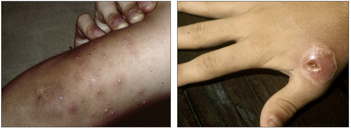 Pustules resulting from IFA stings (left image); secondary infection on a hand as a result of an IFA sting (right image)